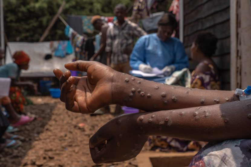 France reports first case of new mpox variant