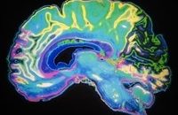 Heavy drinking linked to increased risk of brain lesions