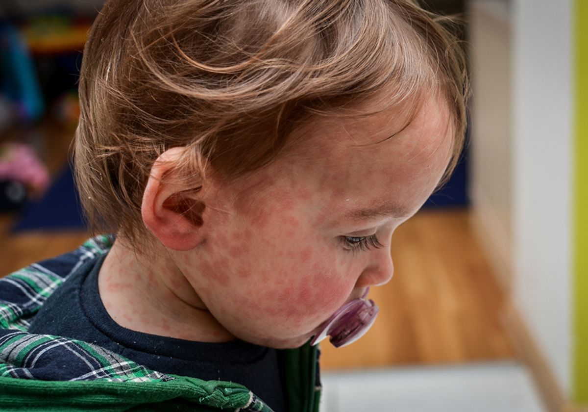 Track the spread of measles in Texas