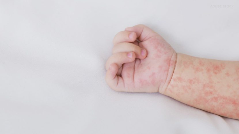WA Health issues measles update
