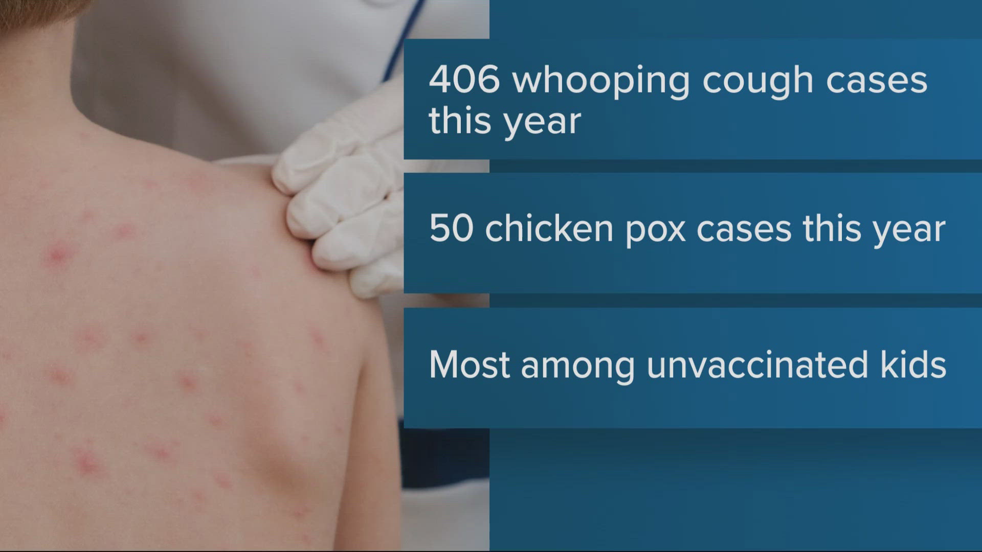 Whooping cough cases on the rise with measles